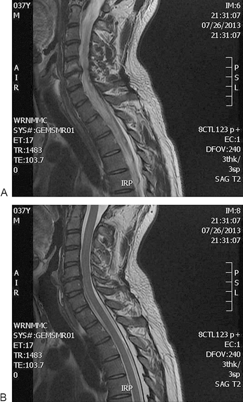 Cervical Disc Arthroplasty — Fig. 2