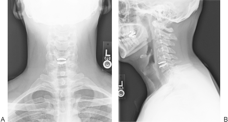 Cervical Disc Arthroplasty — Fig. 3