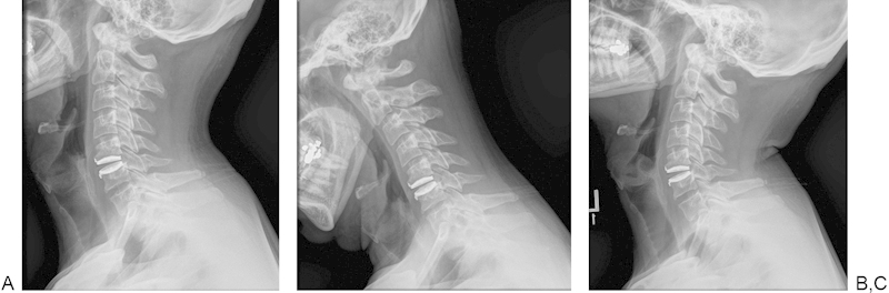 Cervical Disc Arthroplasty — Fig. 4