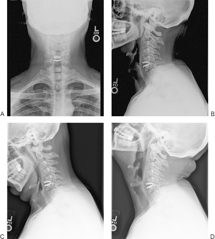 Cervical Disc Arthroplasty — Fig. 6