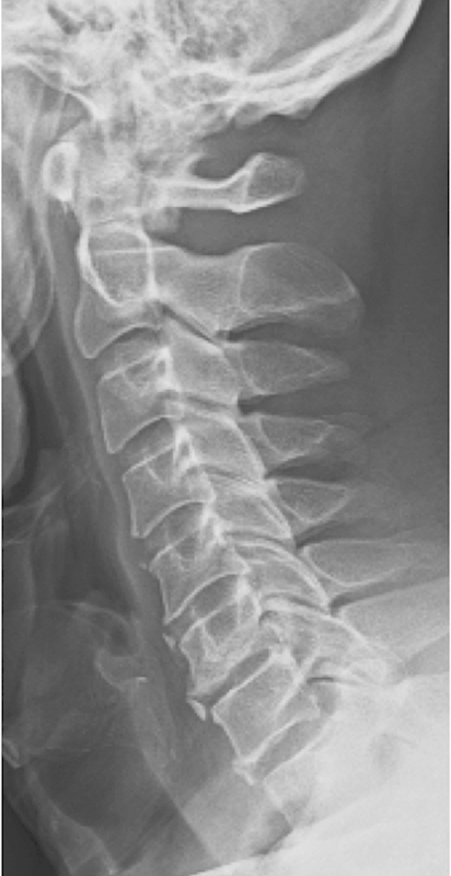 Cervical Laminoplasty — Fig. 2