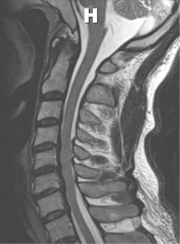 Cervical Laminoplasty — Fig. 3