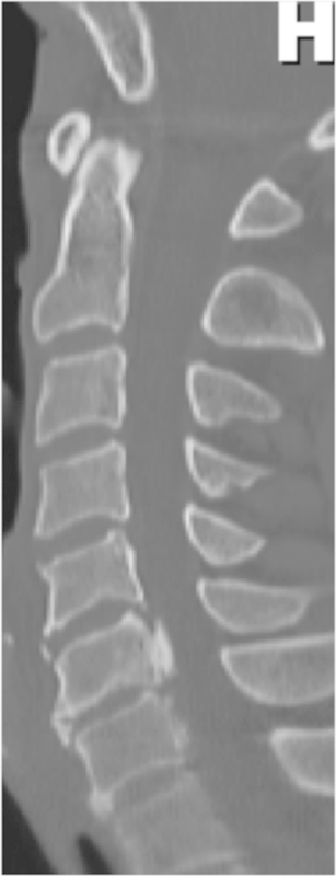 Cervical Laminoplasty — Fig. 4