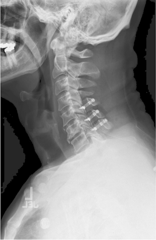 Cervical Laminoplasty — Fig. 5