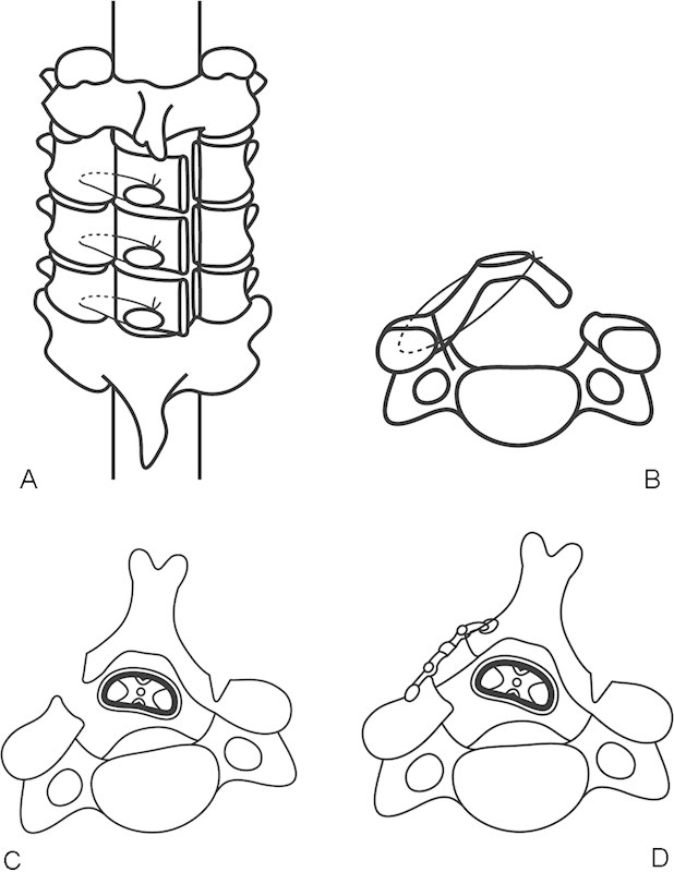 Cervical Laminoplasty — Figure 1