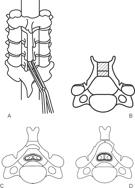 Cervical Laminoplasty — Figure 2