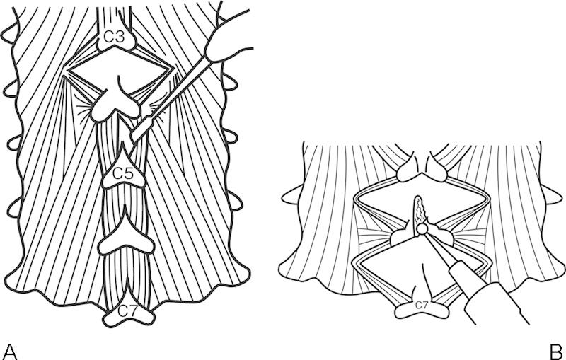 Cervical Laminoplasty — Figure 3