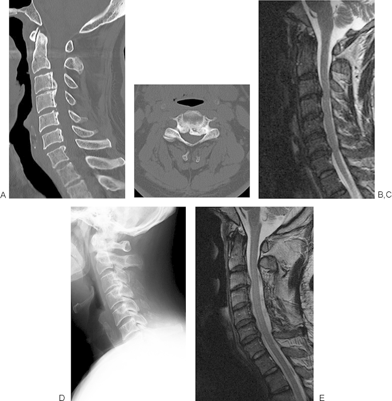 Cervical Laminoplasty — Figure 4