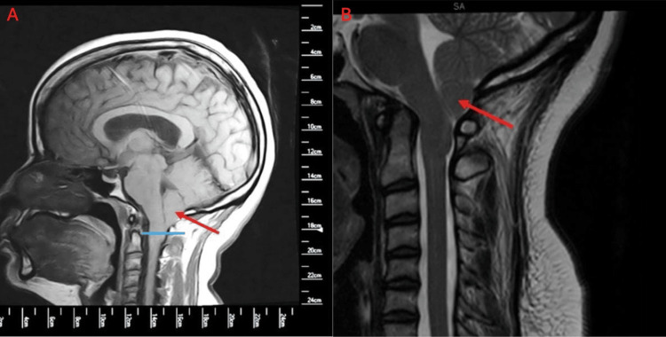 Chiari I Malformation Decompression — Figure 2