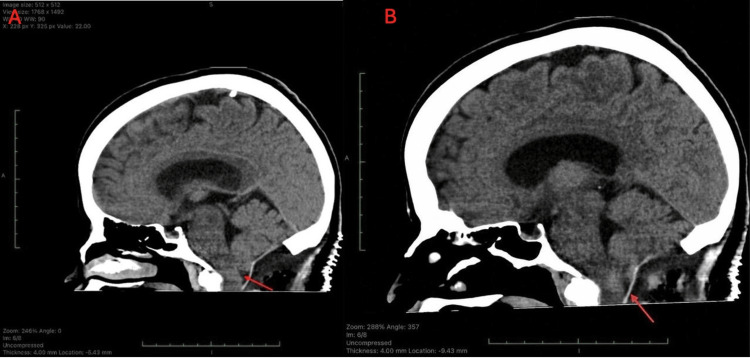 Chiari I Malformation Decompression — Figure 3