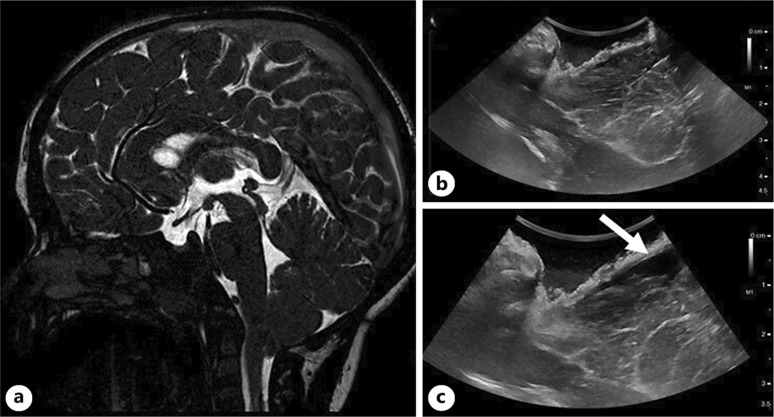 Chiari I Malformation Decompression — Fig. 2.