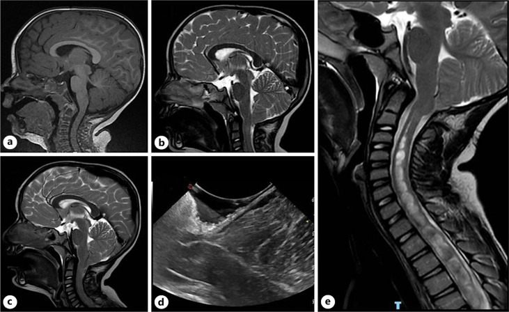Chiari I Malformation Decompression — Fig. 3.