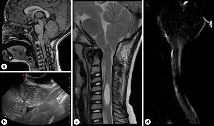 Chiari I Malformation Decompression — Fig. 4.