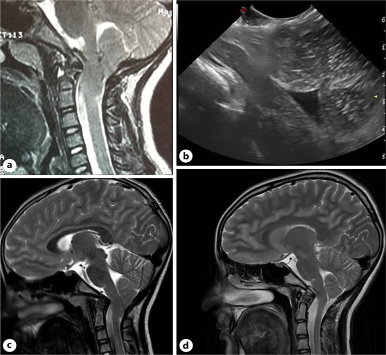 Chiari I Malformation Decompression — Fig. 5.