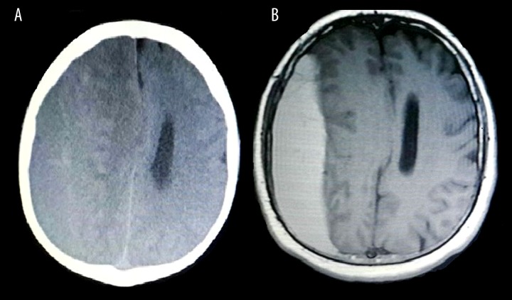 Chronic Subdural Hematoma Evacuation — Figure 1.