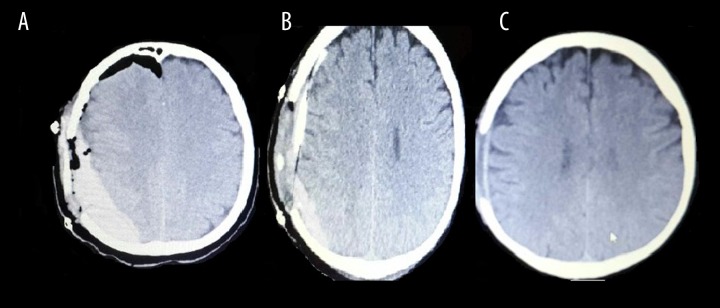 Chronic Subdural Hematoma Evacuation — Figure 2.