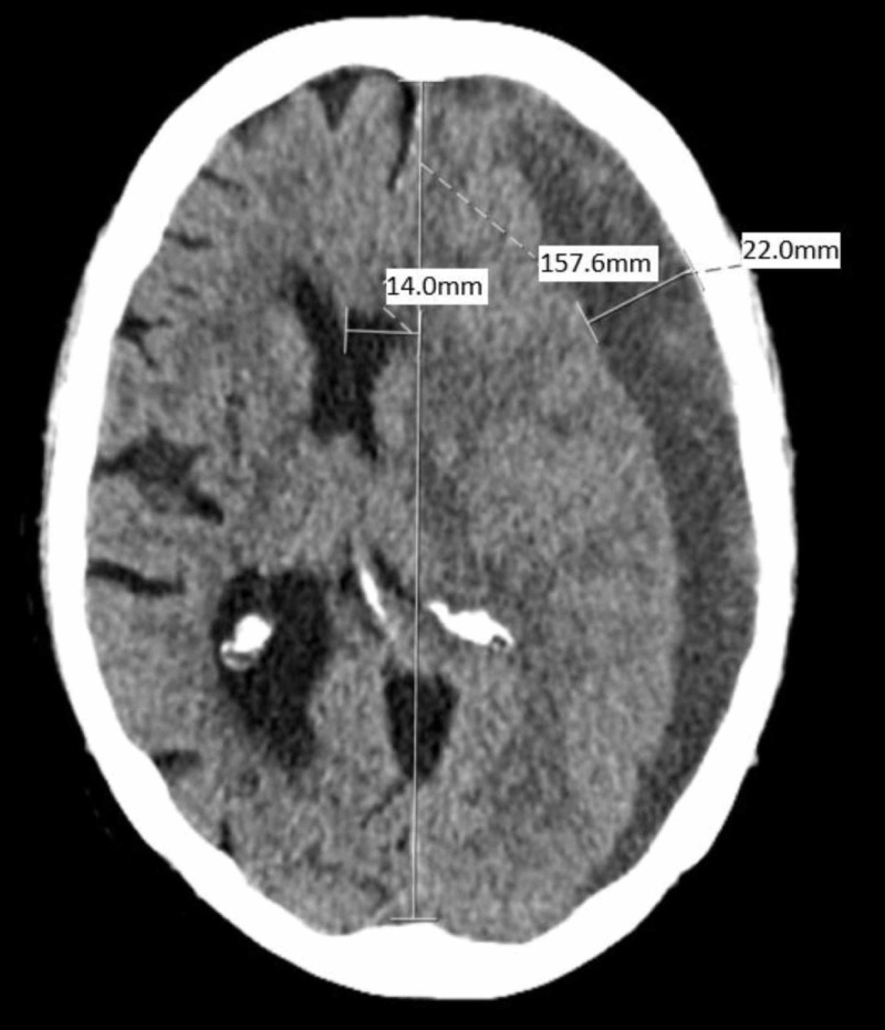 Chronic Subdural Hematoma Evacuation — Figure 1