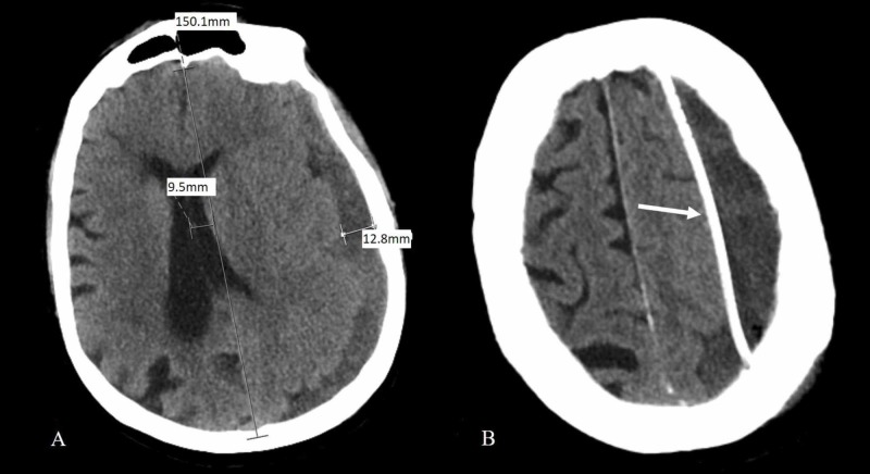 Chronic Subdural Hematoma Evacuation — Figure 2