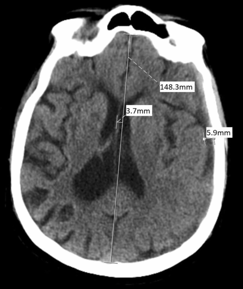 Chronic Subdural Hematoma Evacuation — Figure 3