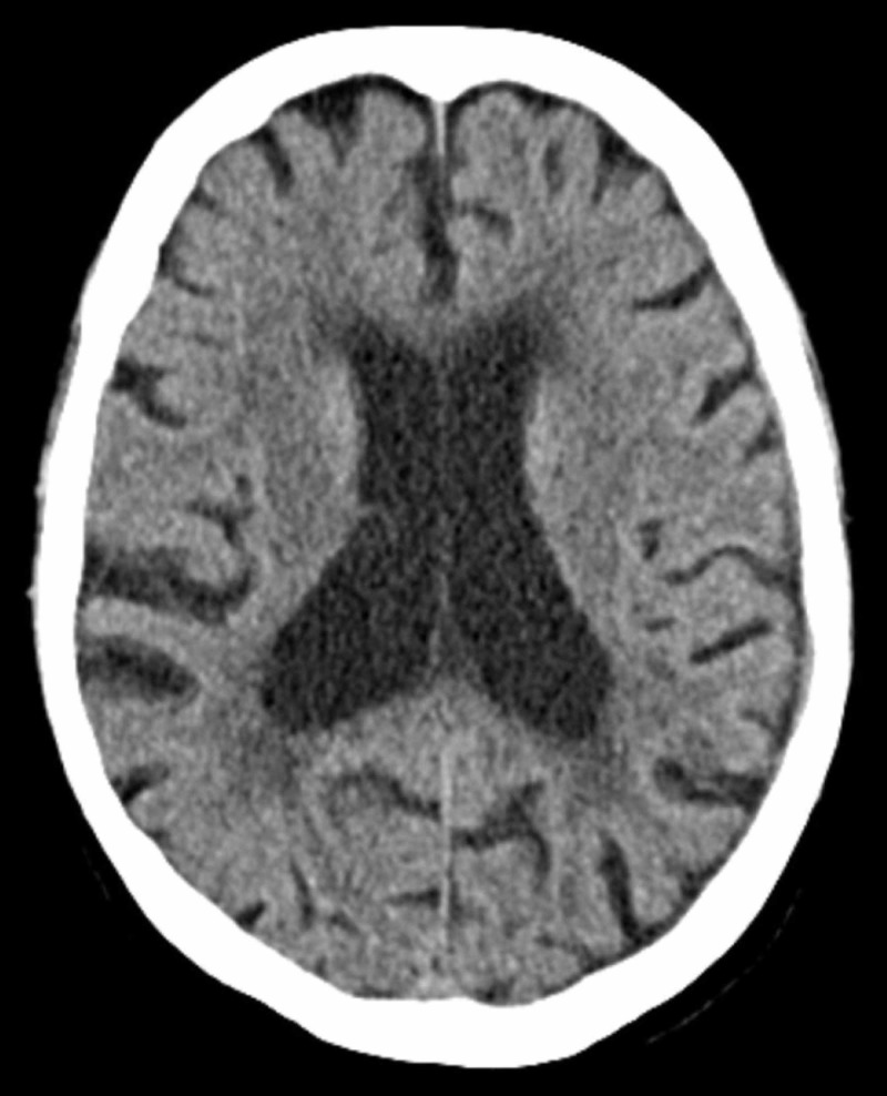 Chronic Subdural Hematoma Evacuation — Figure 4