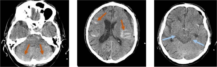 Chronic Subdural Hematoma Evacuation — FIGURE 2
