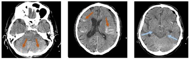 Chronic Subdural Hematoma Evacuation — Figure 9