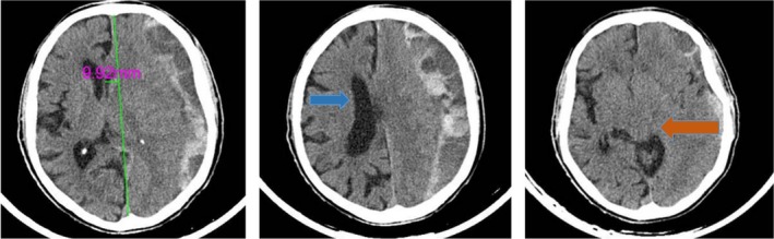 Chronic Subdural Hematoma Evacuation — FIGURE 1