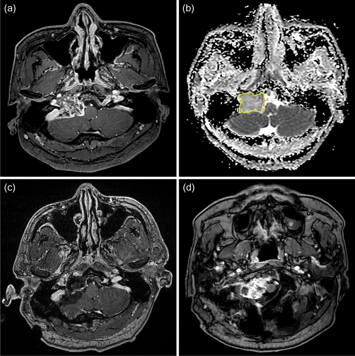 Clival Chordoma Resection — Figure 4
