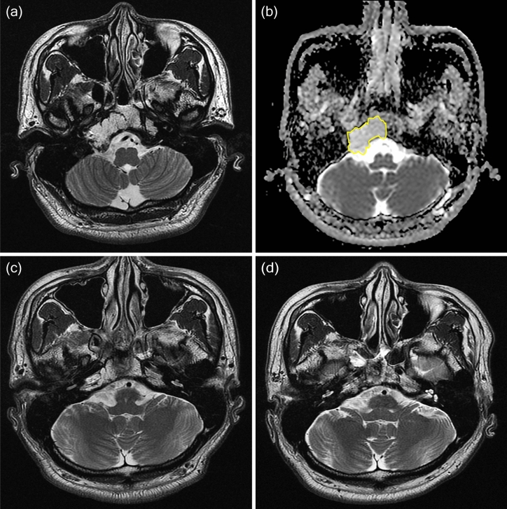 Clival Chordoma Resection — Figure 5