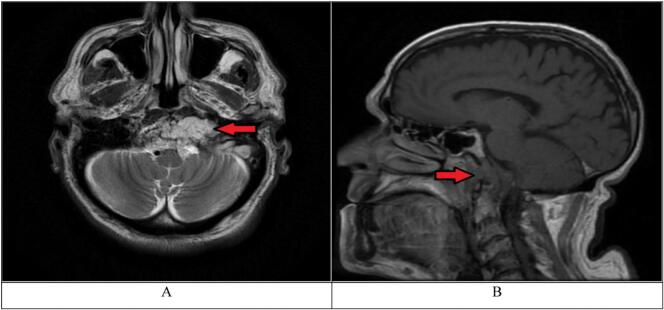 Clival Chordoma Resection — Fig. 1
