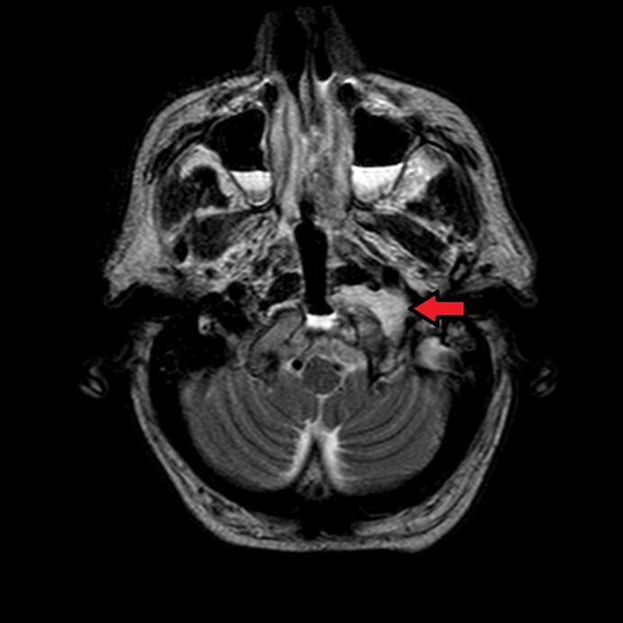 Clival Chordoma Resection — Fig. 2