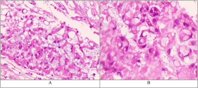 Clival Chordoma Resection — Fig. 3