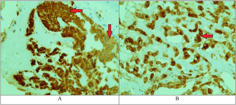 Clival Chordoma Resection — Fig. 4