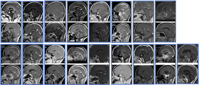 Clival Chordoma Resection — Figure 1