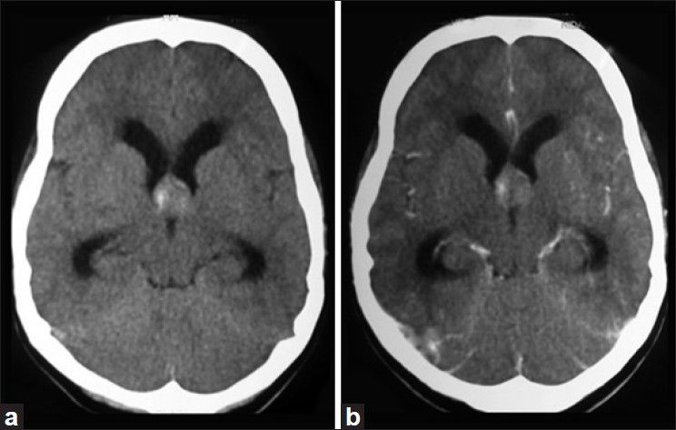 Colloid Cyst Resection — Figure 1