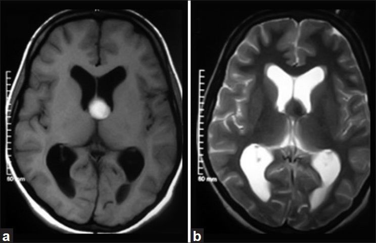 Colloid Cyst Resection — Figure 2