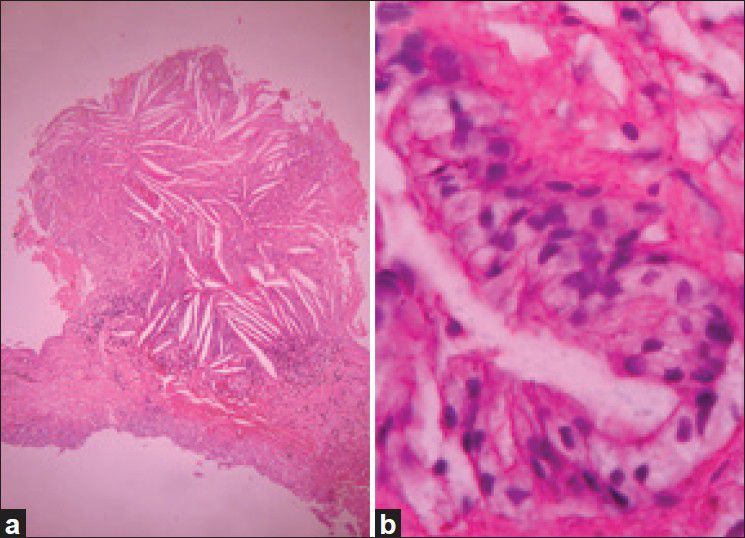 Colloid Cyst Resection — Figure 3