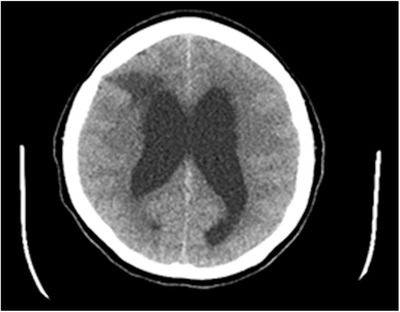 Colloid Cyst Resection — FIGURE 2