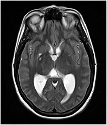 Colloid Cyst Resection — FIGURE 6