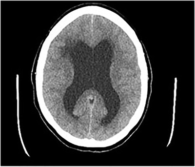 Colloid Cyst Resection — FIGURE 1