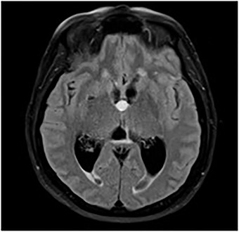 Colloid Cyst Resection — FIGURE 4