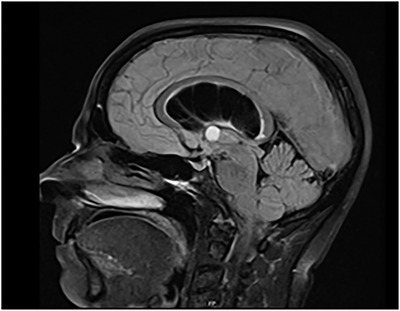 Colloid Cyst Resection — FIGURE 5