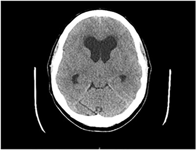 Colloid Cyst Resection — FIGURE 3
