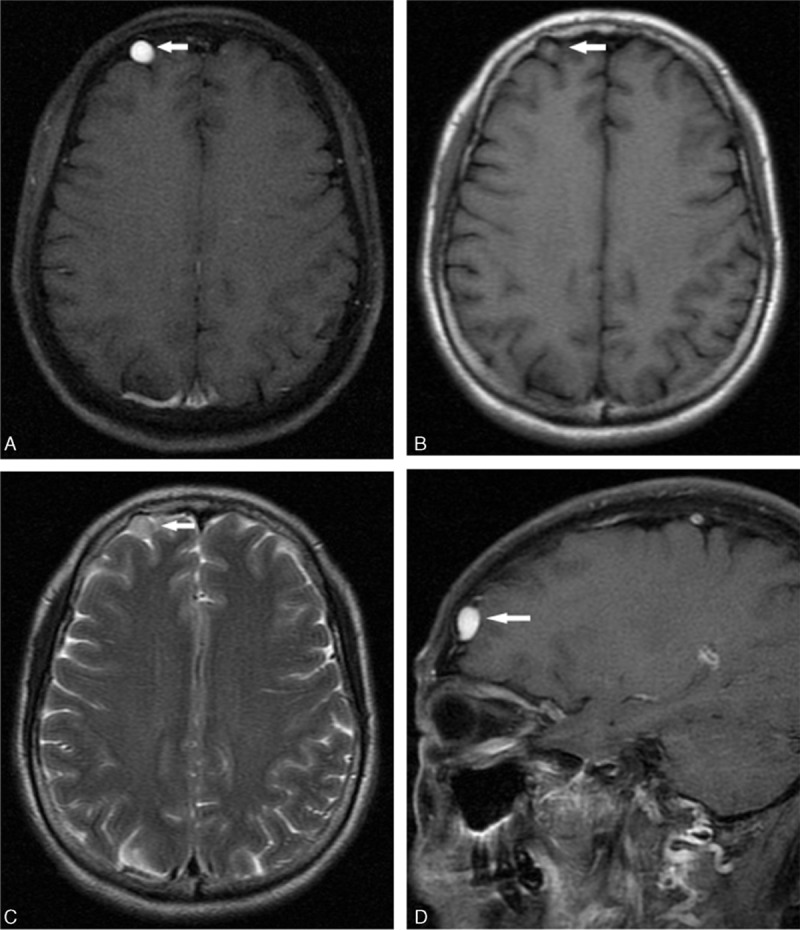 Convexity Meningioma Resection — Figure 1