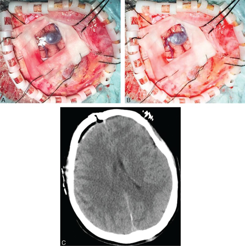 Convexity Meningioma Resection — Figure 2