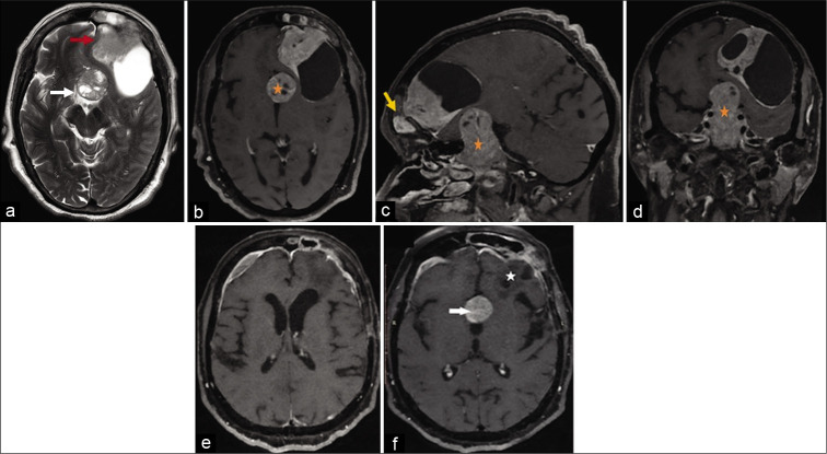Convexity Meningioma Resection — Figure 1: