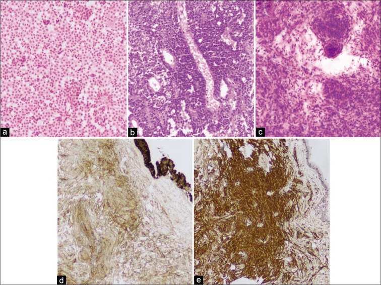 Convexity Meningioma Resection — Figure 2: