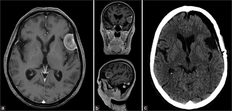 Convexity Meningioma Resection — Figure 1:
