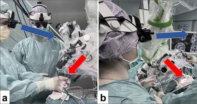 Convexity Meningioma Resection — Figure 2: