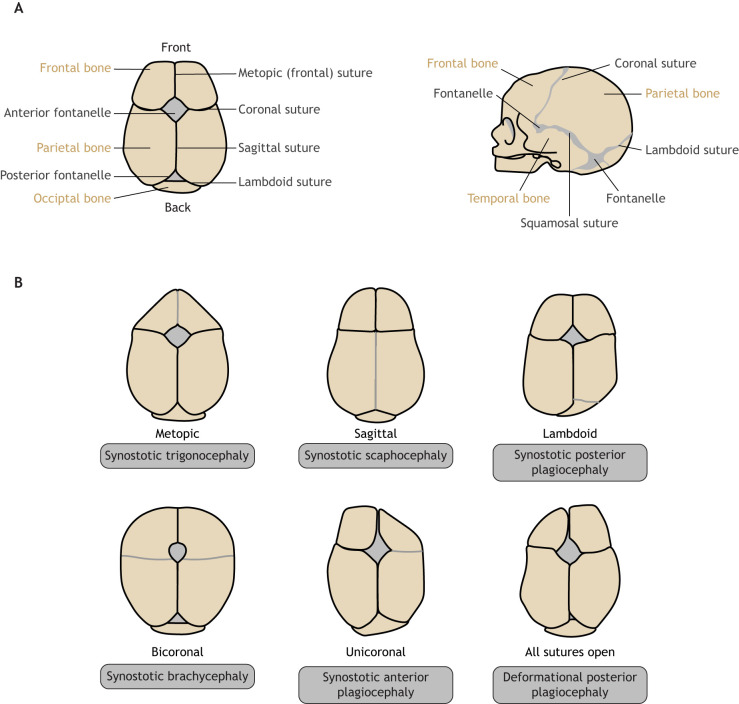 Craniosynostosis Repair — Fig. 1.